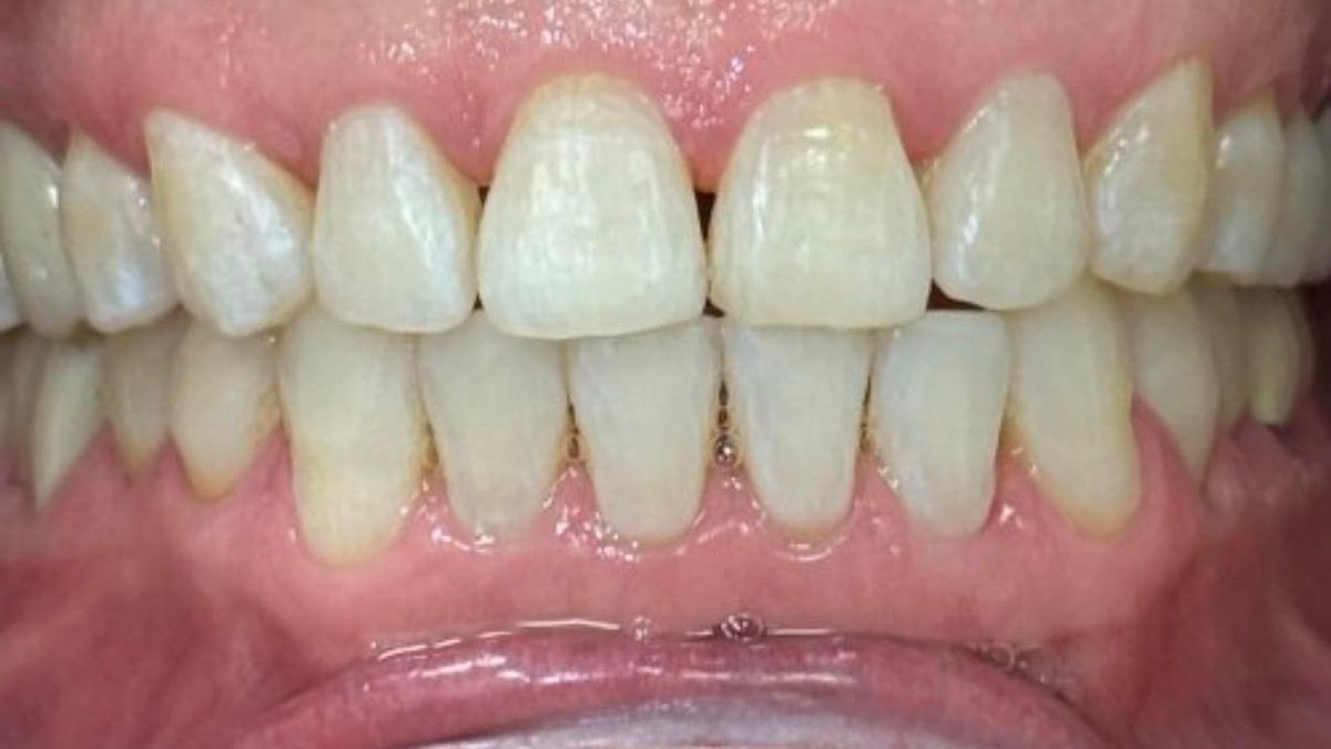 After: aligned, evenly spaced smile