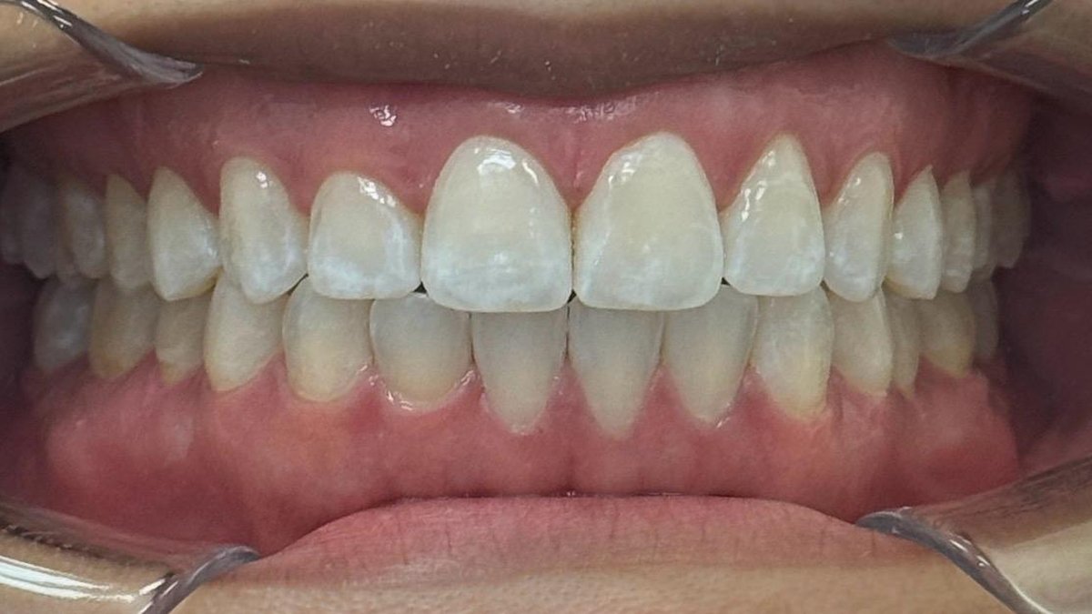 After: closed, aligned bite