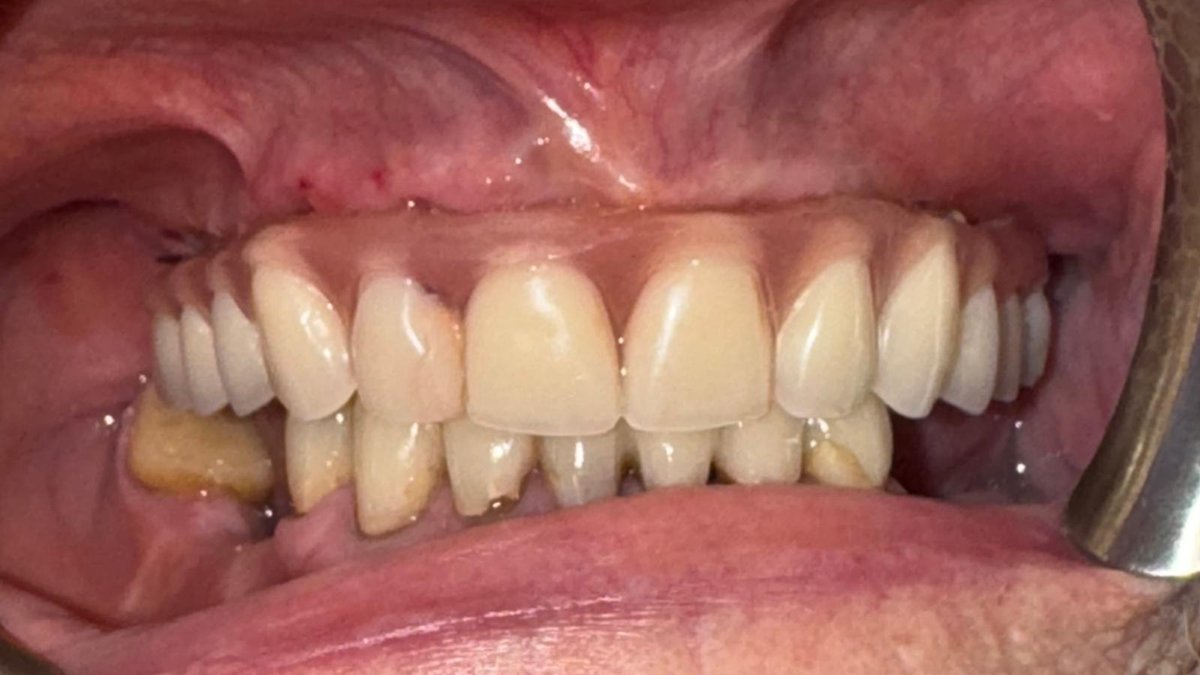 After: fully restored upper arch